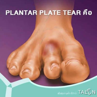 PLANTAR PLATE TEAR คือ