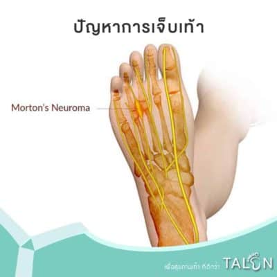 ปัญหาการเจ็บเท้า Morton’s neuroma