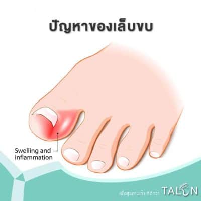 ปัญหาของเล็บขบ