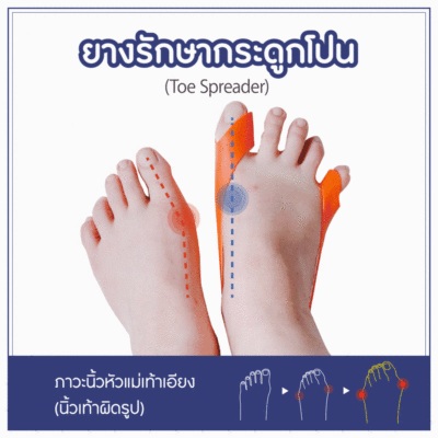 Toe Spreader หรือ ยางดึงกระดูก บริหารกล้ามเนื้อนิ้วเท้า