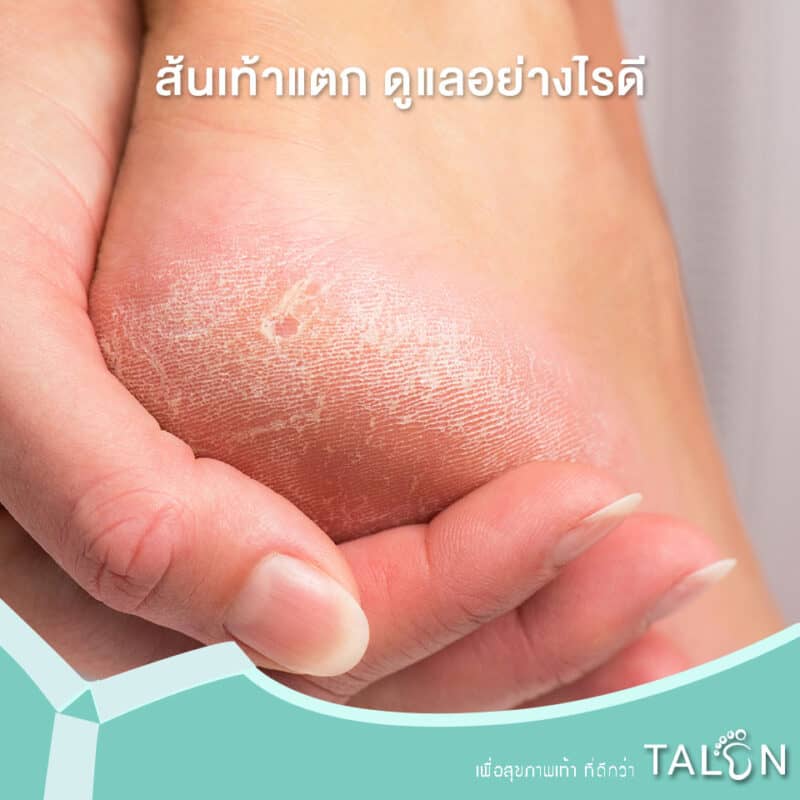 ส้นเท้าแตก-ดูแลอย่างไรดี