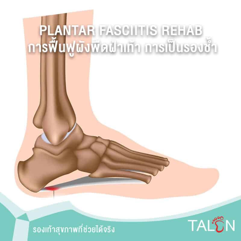 PLANTAR FASCIITIS REHAB การฟื้นฟูผังพืดฝ่าเท้า การเป็นรองช้ำ