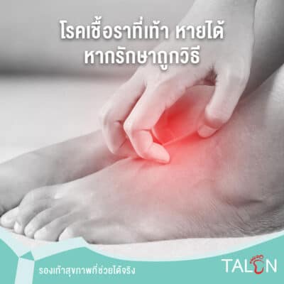 โรคเชื้อราที่เท้า หายได้หากรักษาถูกวิธี