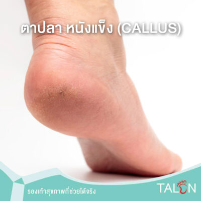 ตาปลา หนังแข็ง (callus)