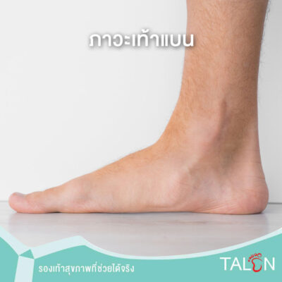 ภาวะเท้าแบน