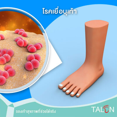 โรคเยื่อบุเท้า