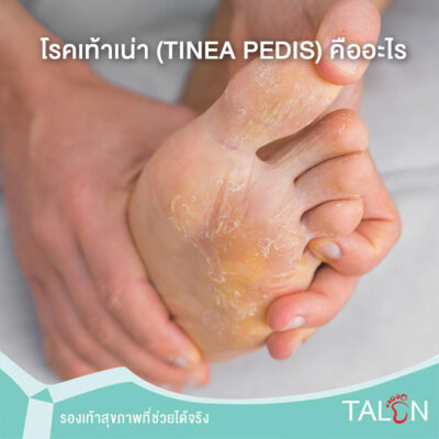 โรคเท้าเน่า (Tinea pedis) คืออะไร