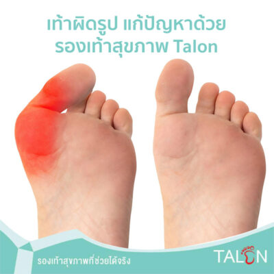 เท้าผิดรูป แก้ปัญหาด้วยรองเท้าสุขภาพ Talon