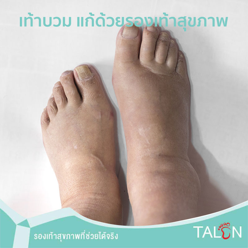 เท้าบวม แก้ด้วยรองเท้าสุขภาพ จริงหรือ?