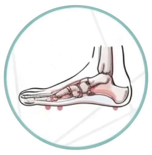 Arch support