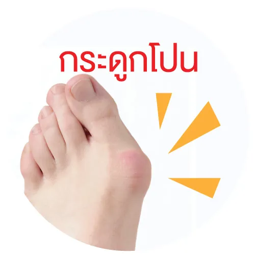 กระดูกโปน