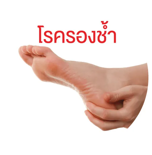 โรครองช้ำ