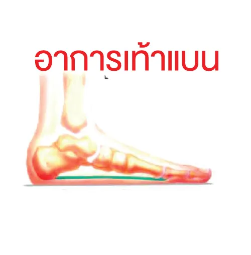 อาการเท้าแบน